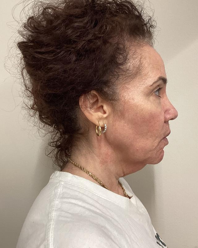 Neck Lift before at DAVinci Plastic Surgery in Washington, DC