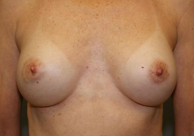 Breast Lift after at DAVinci Plastic Surgery in Washington, DC