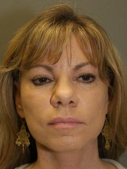 DAVinci Plastic Surgery facelift after — Washington, DC