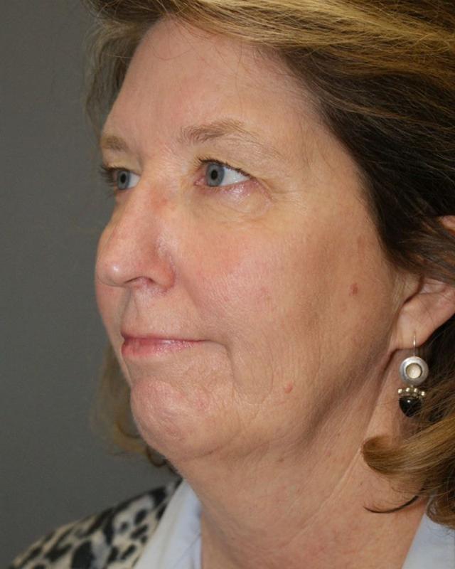 Neck Lift before at DAVinci Plastic Surgery in Washington, DC