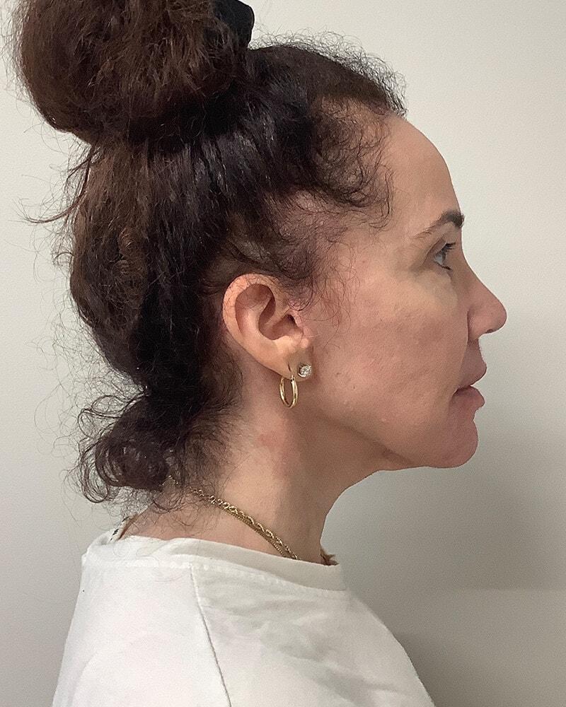DAVinci Plastic Surgery facelift after — Washington, DC