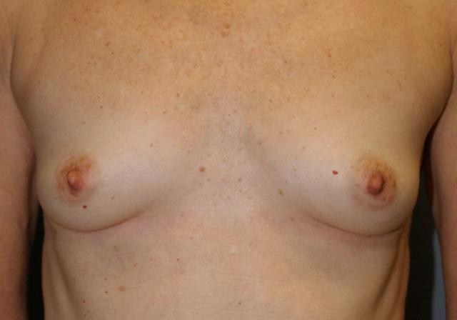 Breast Lift before at DAVinci Plastic Surgery in Washington, DC