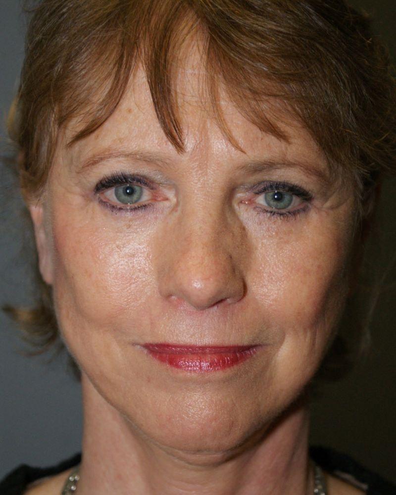 DAVinci Plastic Surgery facelift after — Washington, DC
