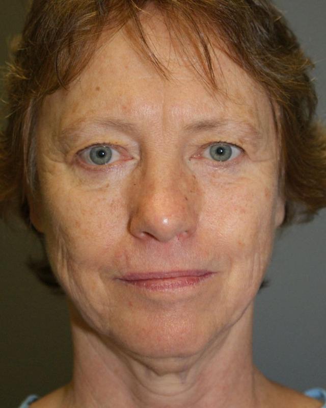 Neck Lift before at DAVinci Plastic Surgery in Washington, DC