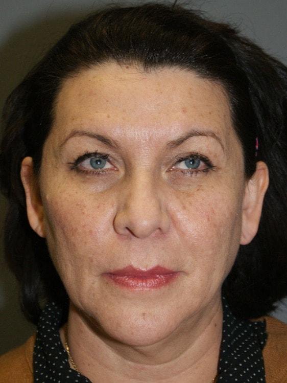 Neck Lift before at DAVinci Plastic Surgery in Washington, DC