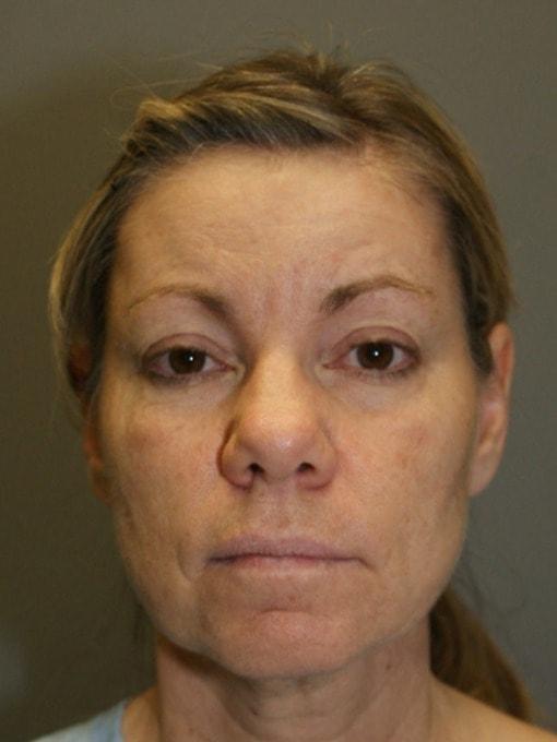 Neck Lift before at DAVinci Plastic Surgery in Washington, DC