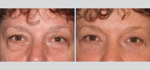 Blepharoplasty result at Main Line Plastic Surgery- Raymond Jean MD in Bryn Mawr, PA