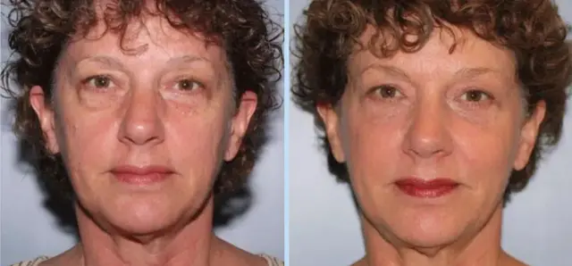 Facelift result at Main Line Plastic Surgery- Raymond Jean MD in Bryn Mawr, PA