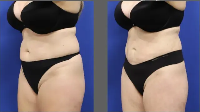 Liposuction result at Main Line Plastic Surgery- Raymond Jean MD in Bryn Mawr, PA