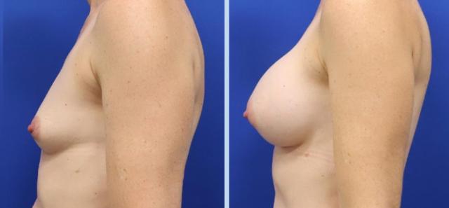 Breast Augmentation result at Main Line Plastic Surgery- Raymond Jean MD in Bryn Mawr, PA