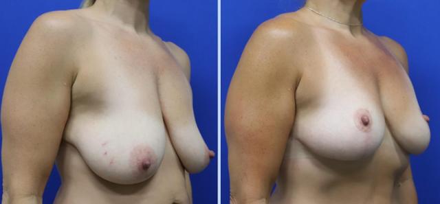 Breast Lift result at Main Line Plastic Surgery- Raymond Jean MD in Bryn Mawr, PA
