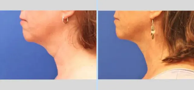 Neck Lift result at Main Line Plastic Surgery- Raymond Jean MD in Bryn Mawr, PA