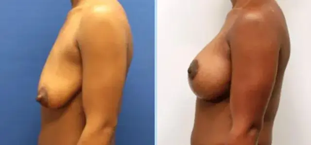Breast Lift result at Main Line Plastic Surgery- Raymond Jean MD in Bryn Mawr, PA