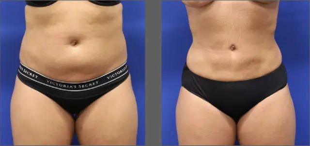 Liposuction result at Main Line Plastic Surgery- Raymond Jean MD in Bryn Mawr, PA
