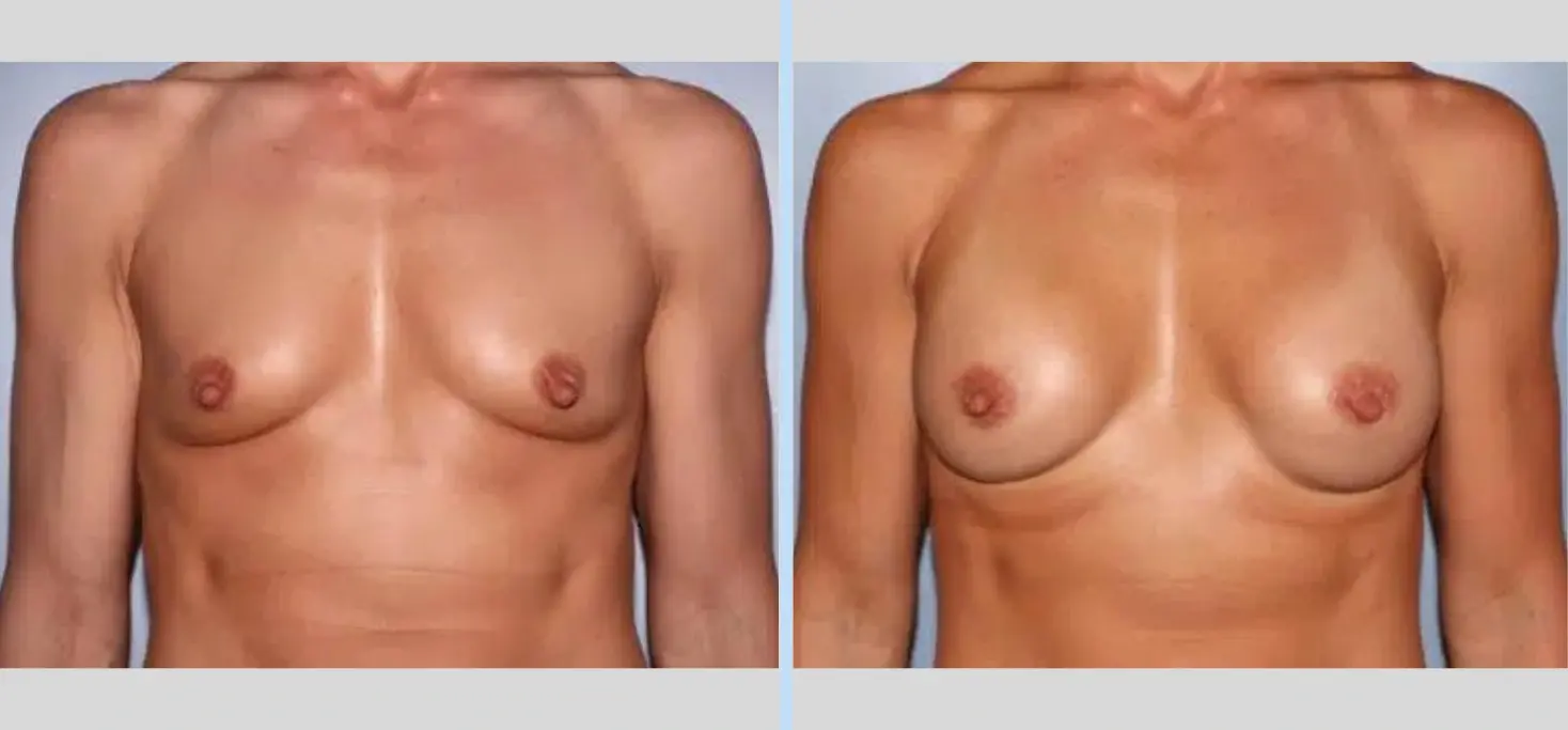 Main Line Plastic Surgery- Raymond Jean MD breast augmentation result — Bryn Mawr, PA