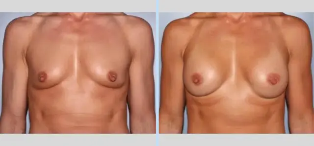 Breast Augmentation result at Main Line Plastic Surgery- Raymond Jean MD in Bryn Mawr, PA