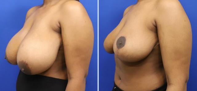 Breast Reduction result at Main Line Plastic Surgery- Raymond Jean MD in Bryn Mawr, PA