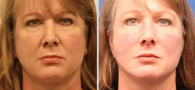 Facelift result at Main Line Plastic Surgery- Raymond Jean MD in Bryn Mawr, PA