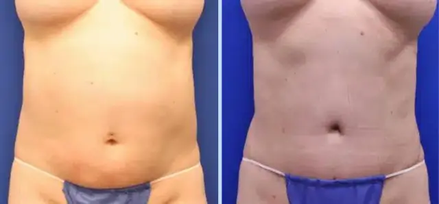 Tummy Tuck result at Main Line Plastic Surgery- Raymond Jean MD in Bryn Mawr, PA