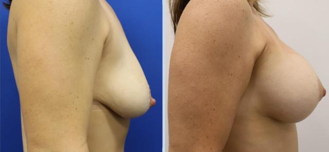 Breast Augmentation result at Main Line Plastic Surgery- Raymond Jean MD in Bryn Mawr, PA