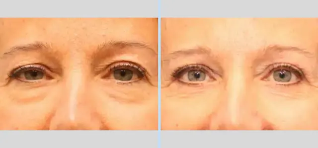 Blepharoplasty result at Main Line Plastic Surgery- Raymond Jean MD in Bryn Mawr, PA