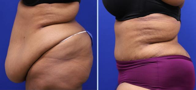 Mini Tummy Tuck result at Main Line Plastic Surgery- Raymond Jean MD in Bryn Mawr, PA