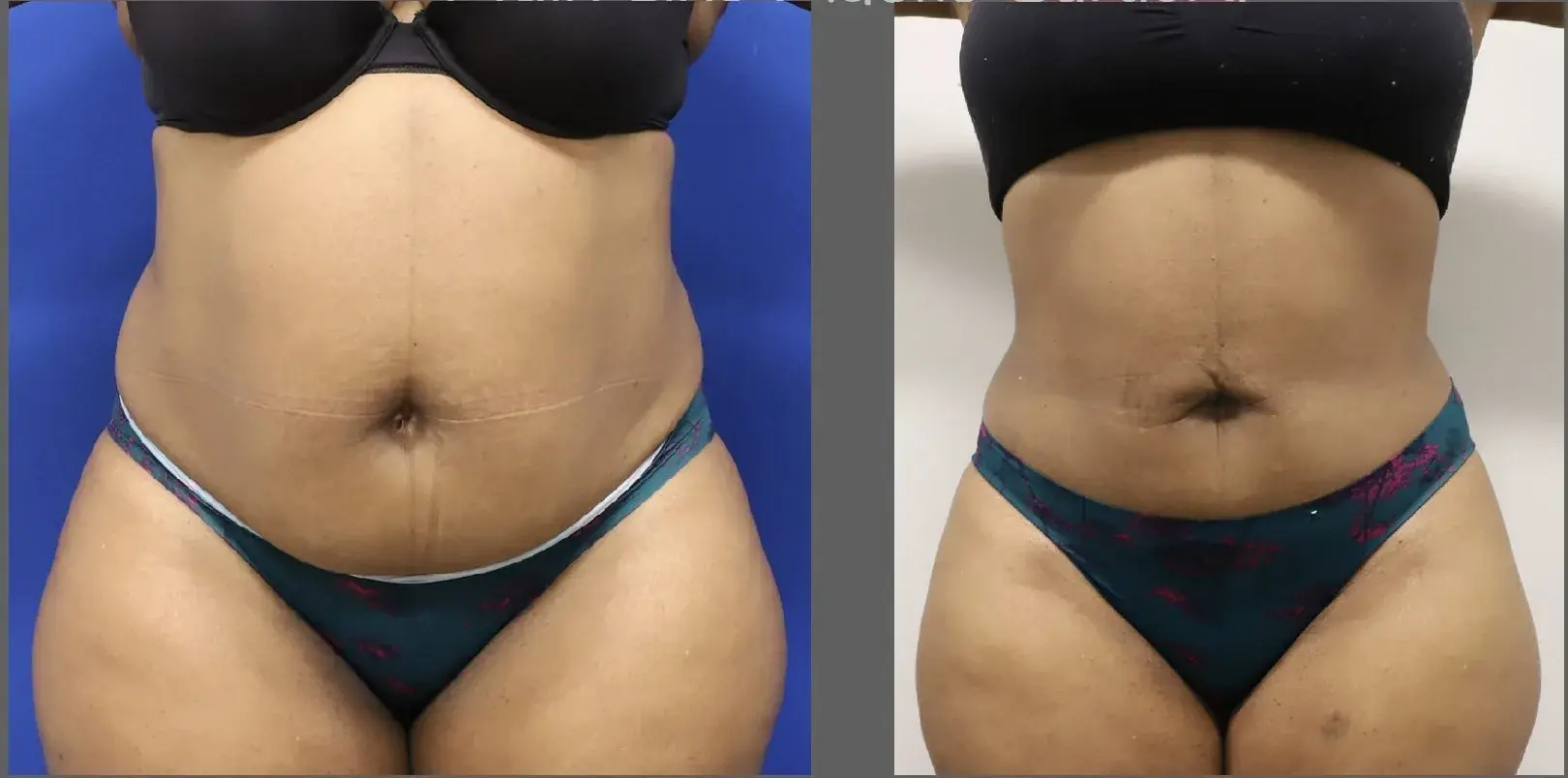 Main Line Plastic Surgery- Raymond Jean MD tummy tuck result — Bryn Mawr, PA