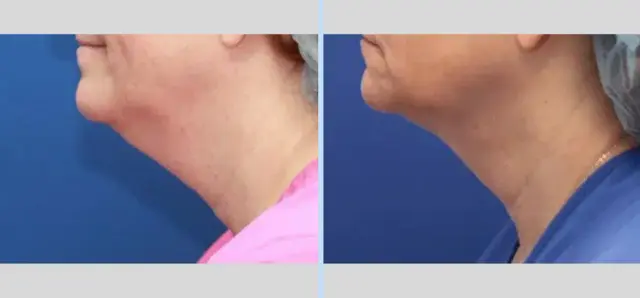 Neck Lift result at Main Line Plastic Surgery- Raymond Jean MD in Bryn Mawr, PA