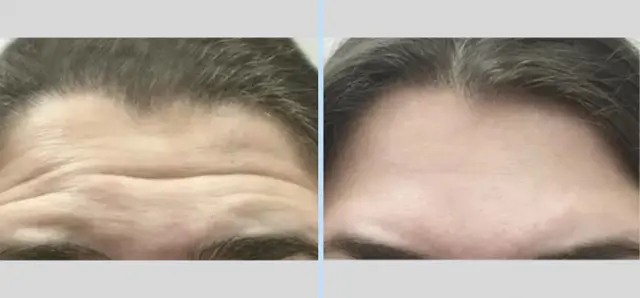 Botox result at Main Line Plastic Surgery- Raymond Jean MD in Bryn Mawr, PA