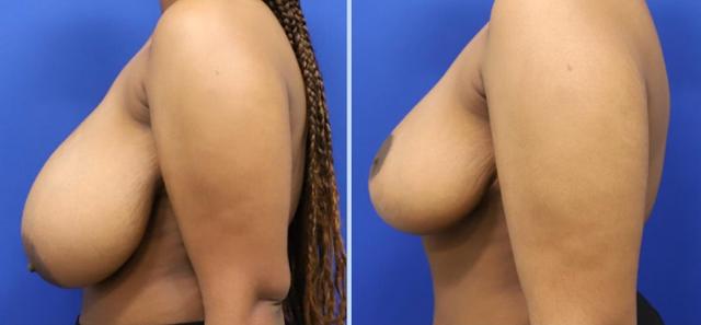 Breast Reduction result at Main Line Plastic Surgery- Raymond Jean MD in Bryn Mawr, PA