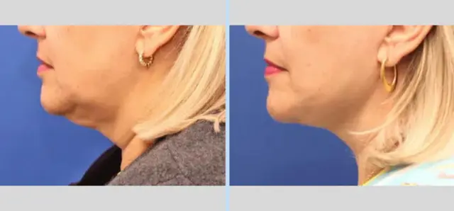Neck Lift result at Main Line Plastic Surgery- Raymond Jean MD in Bryn Mawr, PA