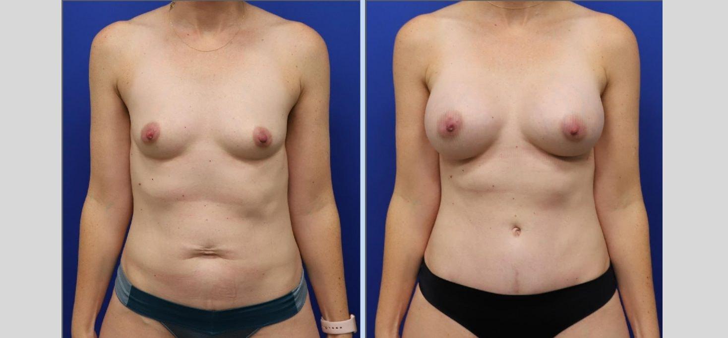 Main Line Plastic Surgery- Raymond Jean MD mommy makeover result — Bryn Mawr, PA