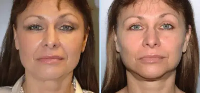 Facelift result at Main Line Plastic Surgery- Raymond Jean MD in Bryn Mawr, PA
