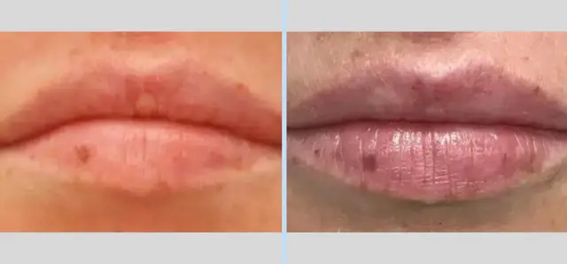 Juvederm result at Main Line Plastic Surgery- Raymond Jean MD in Bryn Mawr, PA