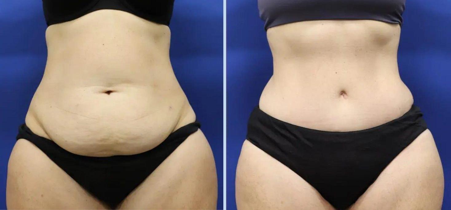 Main Line Plastic Surgery- Raymond Jean MD mommy makeover result — Bryn Mawr, PA