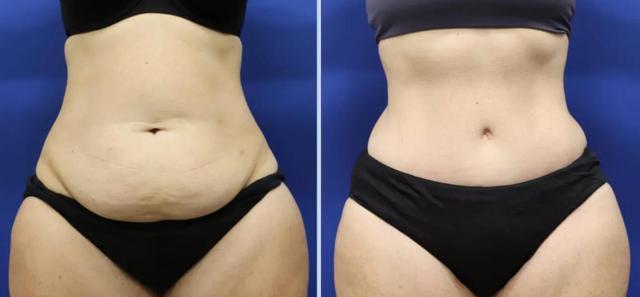 Mommy Makeover result at Main Line Plastic Surgery- Raymond Jean MD in Bryn Mawr, PA