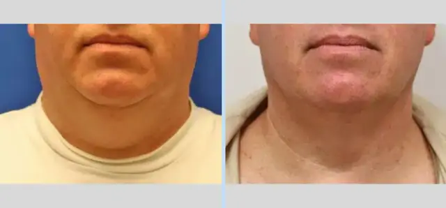 Neck Lift result at Main Line Plastic Surgery- Raymond Jean MD in Bryn Mawr, PA