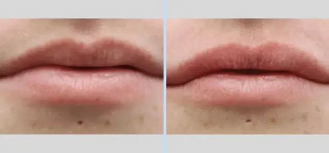 Juvederm result at Main Line Plastic Surgery- Raymond Jean MD in Bryn Mawr, PA