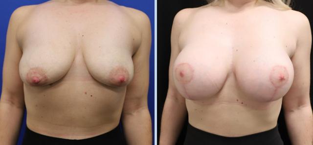Breast Augmentation result at Main Line Plastic Surgery- Raymond Jean MD in Bryn Mawr, PA