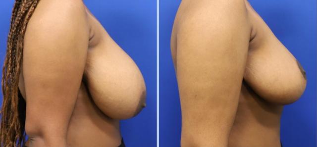 Breast Reduction result at Main Line Plastic Surgery- Raymond Jean MD in Bryn Mawr, PA