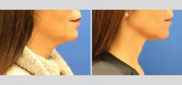 Neck Lift result at Main Line Plastic Surgery- Raymond Jean MD in Bryn Mawr, PA