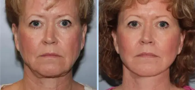 Facelift result at Main Line Plastic Surgery- Raymond Jean MD in Bryn Mawr, PA