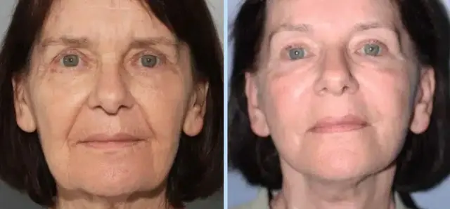 Facelift result at Main Line Plastic Surgery- Raymond Jean MD in Bryn Mawr, PA