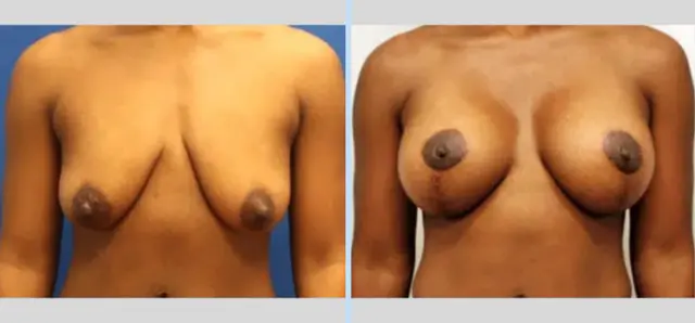 Breast Lift result at Main Line Plastic Surgery- Raymond Jean MD in Bryn Mawr, PA