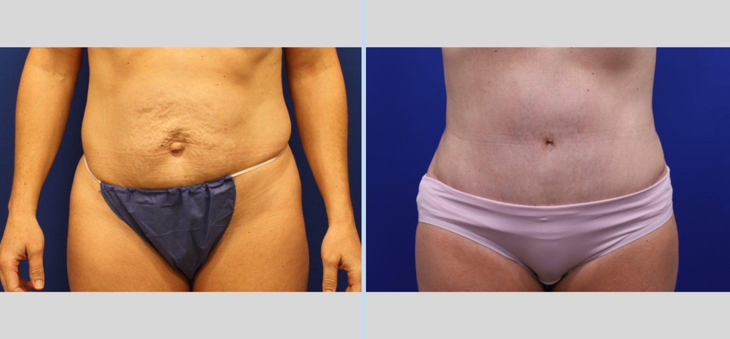 Main Line Plastic Surgery- Raymond Jean MD tummy tuck result — Bryn Mawr, PA