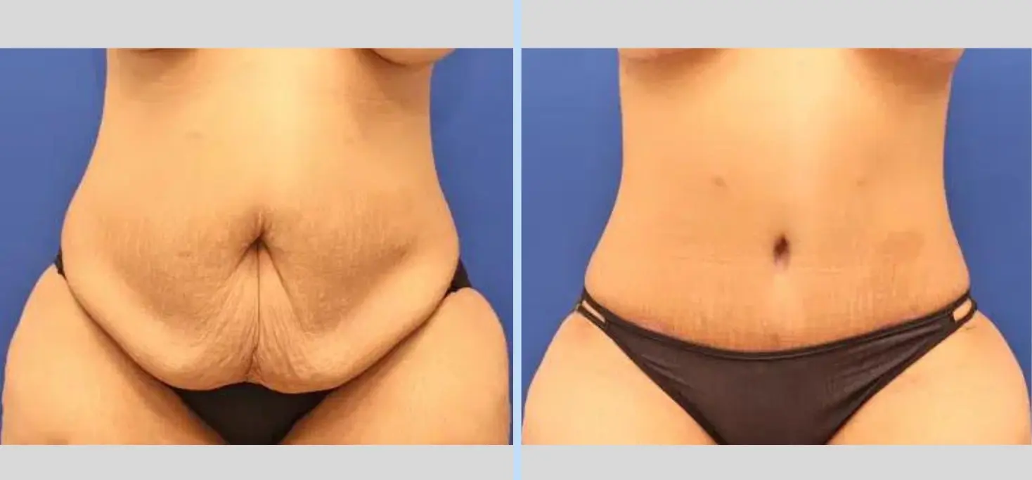 Main Line Plastic Surgery- Raymond Jean MD tummy tuck result — Bryn Mawr, PA