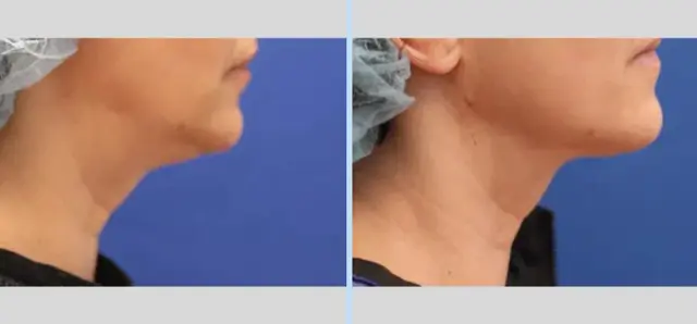 Neck Lift result at Main Line Plastic Surgery- Raymond Jean MD in Bryn Mawr, PA