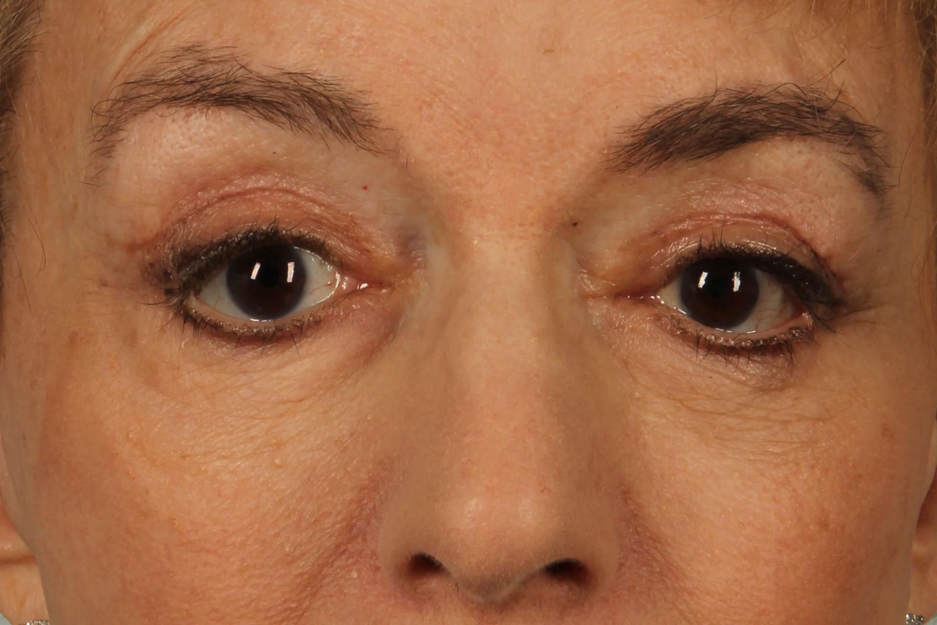 Alan B. Brackup, MD eyelid lift after — Langhorne, PA