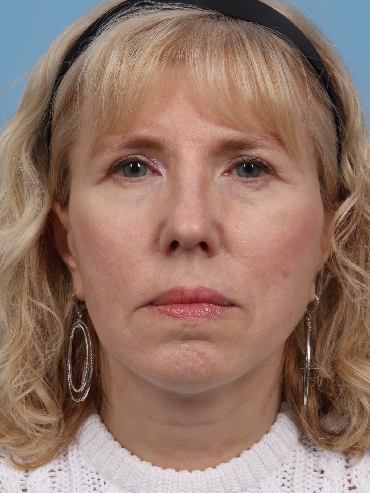 Alan B. Brackup, MD facelift after — Langhorne, PA