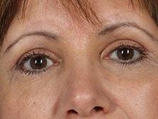 Alan B. Brackup, MD brow lift after — Langhorne, PA